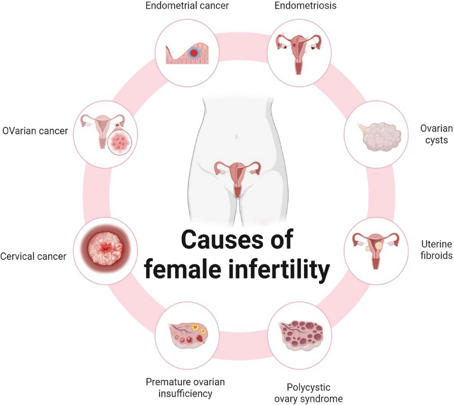Three-Dimensional Bioprinting and Infertility-Related Female Reproductive System Diseases: A Review of Current and Future Applications