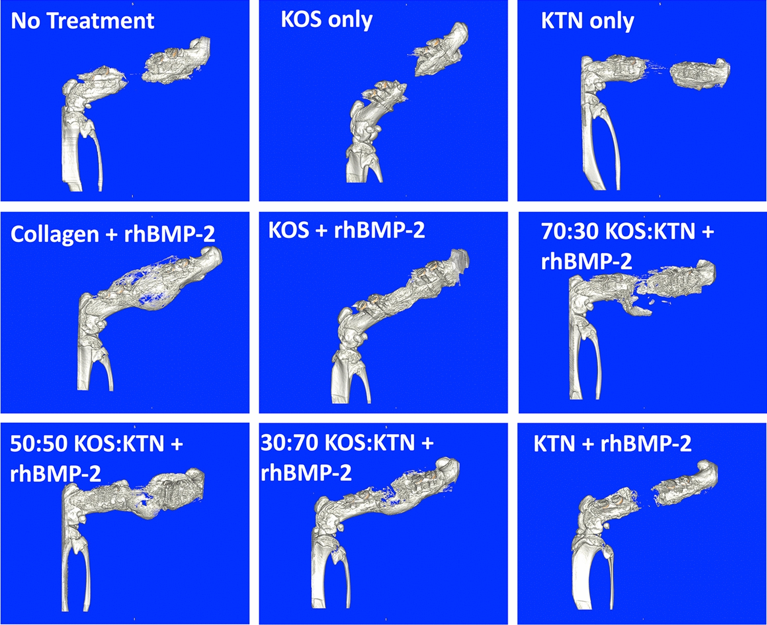 Keratin Scaffold Formulation Impacts rhBMP-2 Biodistribution and Bone Regeneration in a Rat Femur Defect Model