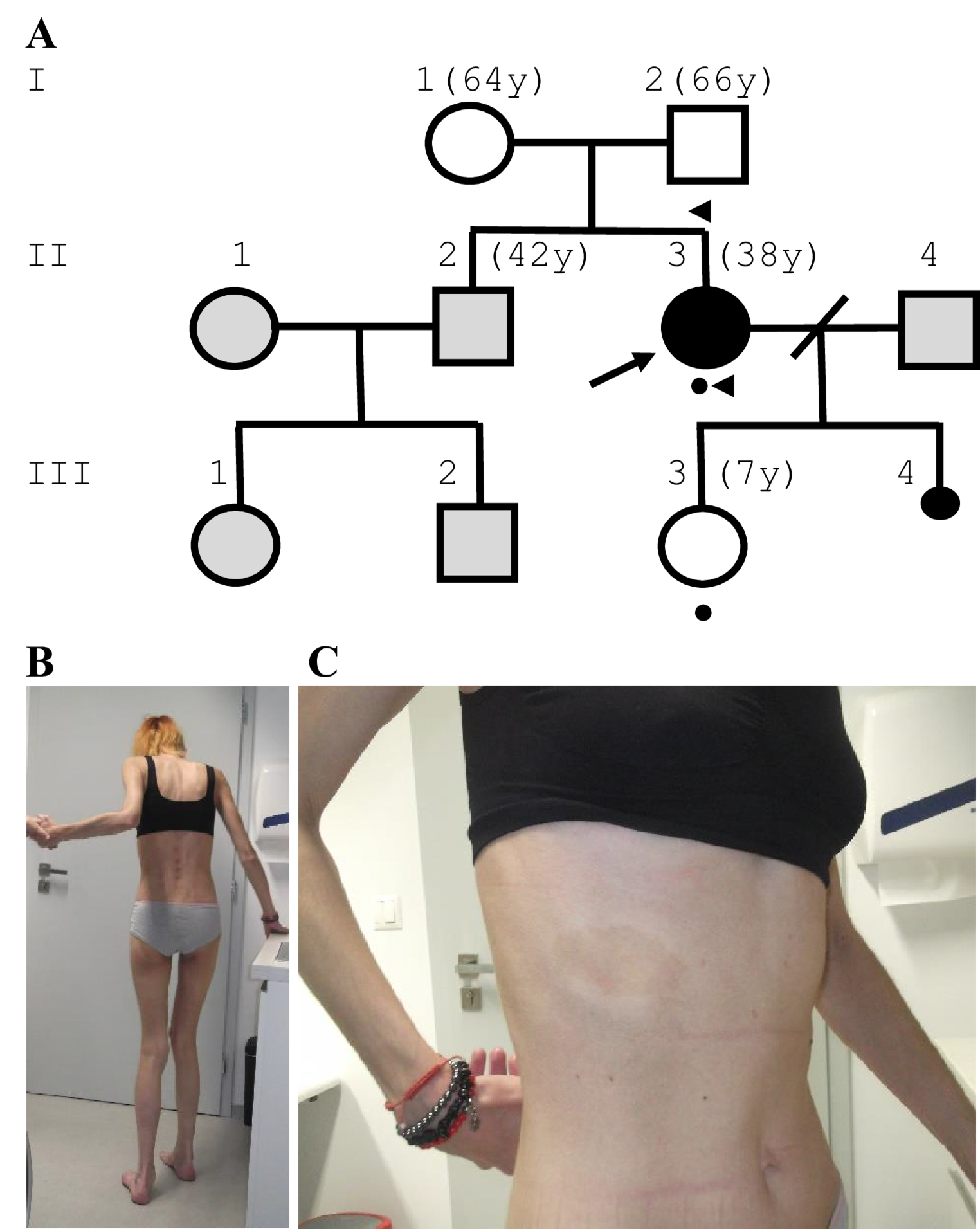 A monoallelic 8q24.3-duplication involving a single protein encoding  gene may be linked to a new leukodystrophy