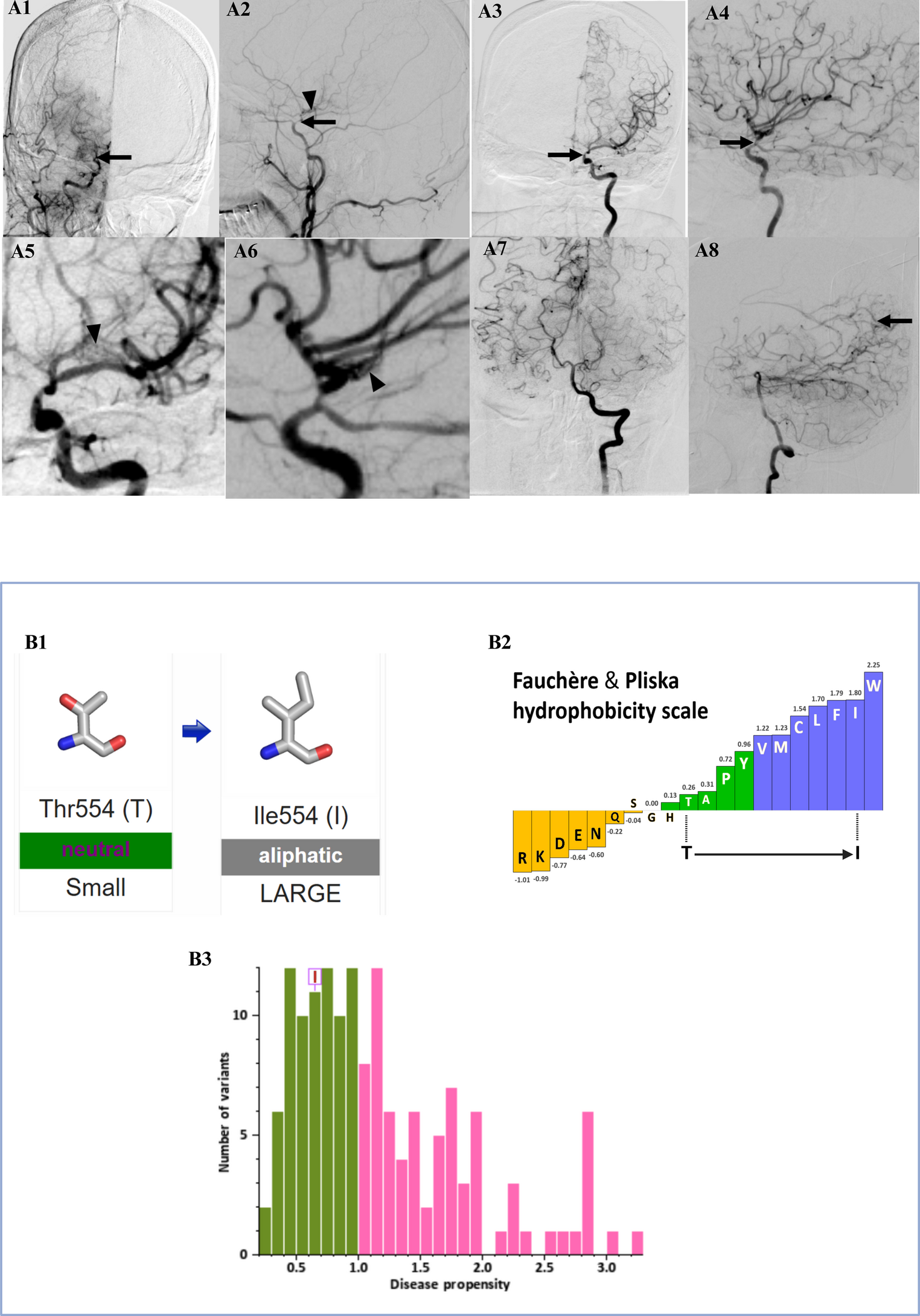 Moyamoya disease presenting with transient nonfocal neurological attacks in an Indian woman carrying a previously unreported RNF213 missense variant (p.Thr554Ile)