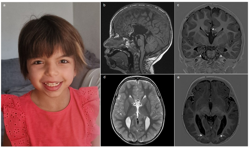 Complete commissural agenesis in a child with Noonan-like syndrome with loose anagen hair 2