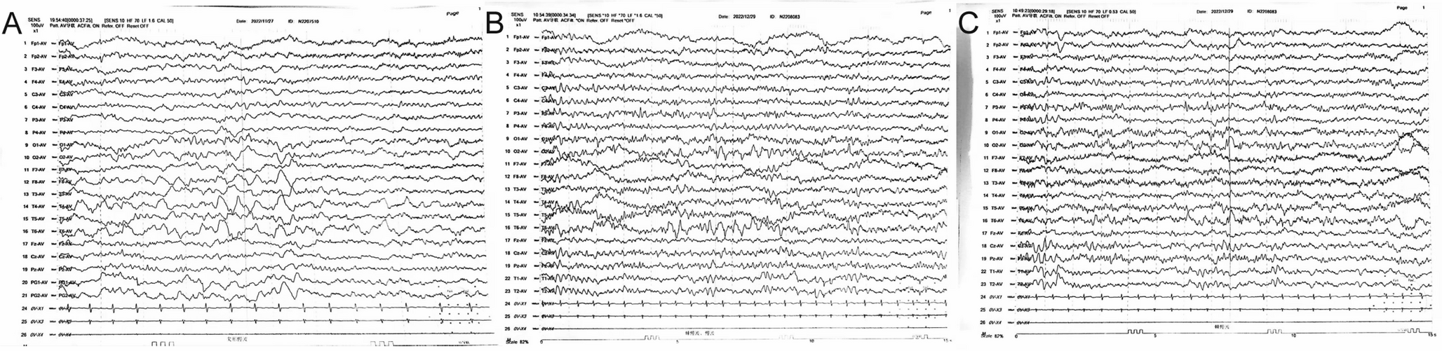 Identification of a de Novo  gene variant in a patient with autism spectrum disorder, epilepsy, and neurodevelopmental delay