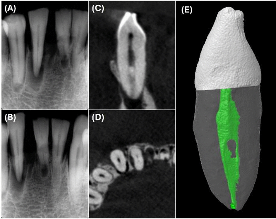 Assessment of unfilled and filled canals in mandibular incisors: comparison between periapical radiography and cone-beam computed tomography