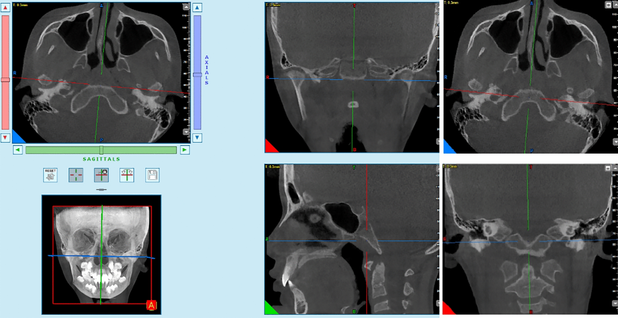 CBCT study of adenoid and nasopharyngeal airway in boys with unilateral complete cleft lip and palate