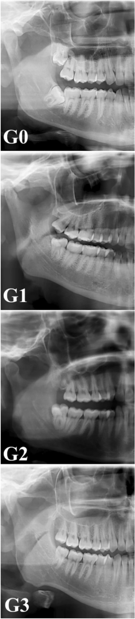 Impact of bruxism on the mandibular angle and condylar structures: a panoramic radiographic assessment