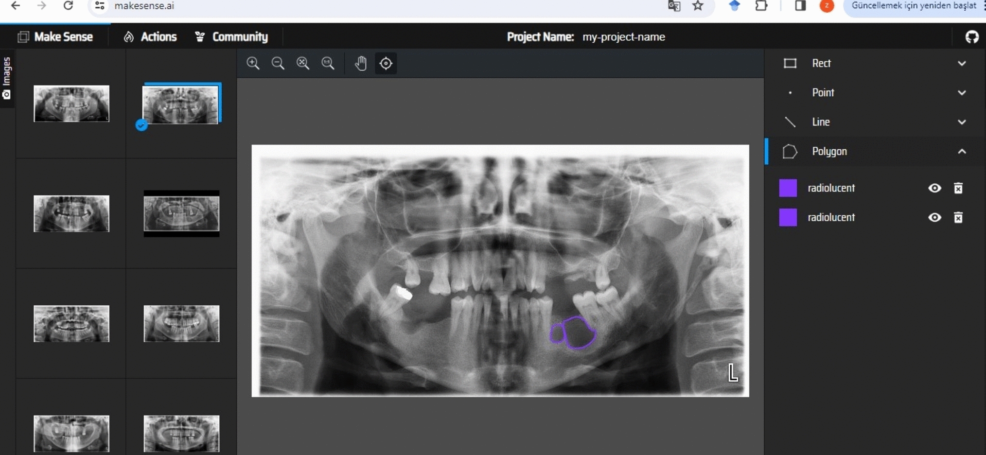 Evaluation of the effectiveness of artificial intelligence models in radiopaque and radiolucent lesions of the maxillofacial region on panoramic radiographs