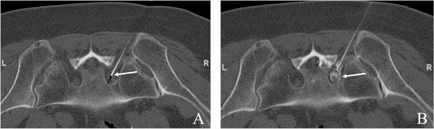 Multicentric prospective study on computed tomography-guided periradicular infiltration and facet joint infiltration