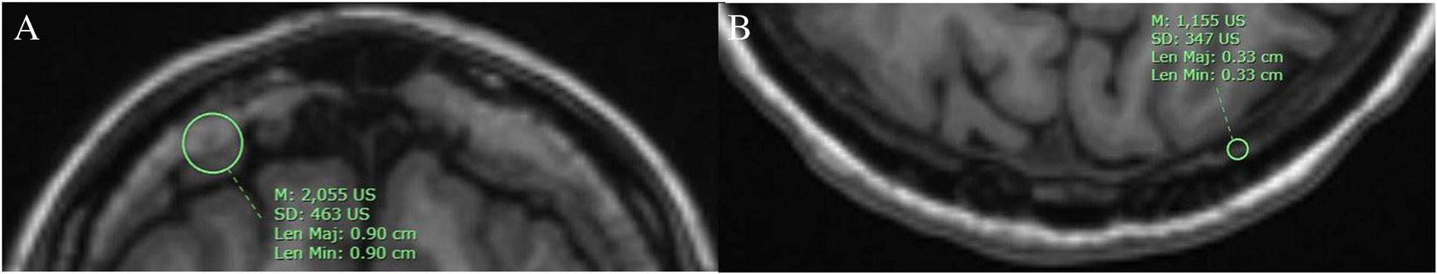 MRI evaluation of hyperostosis frontalis interna: differentiation and diagnostic insights