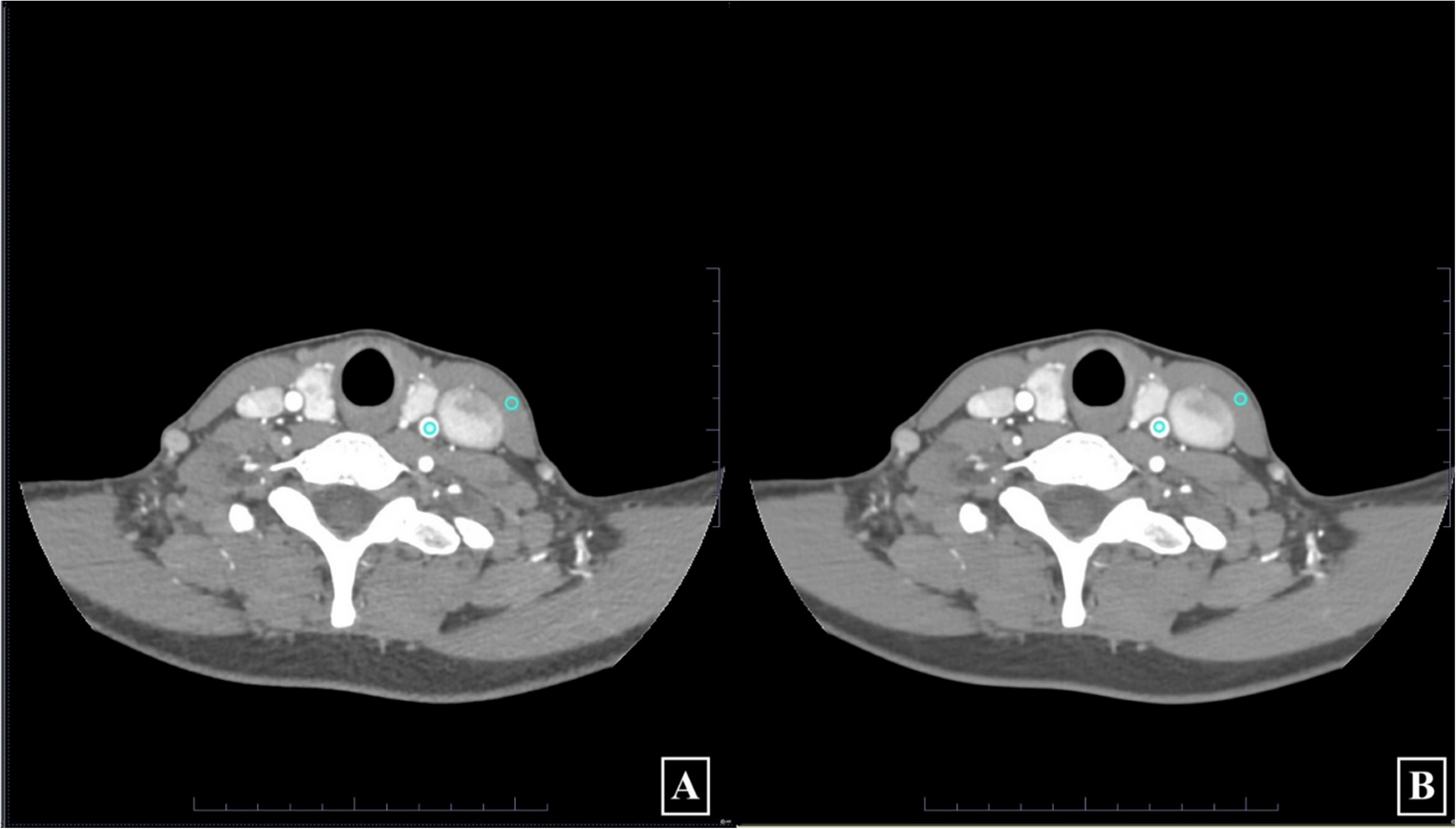 Improved CTA imaging for stroke evaluation – deep learning and iterative reconstruction comparative study