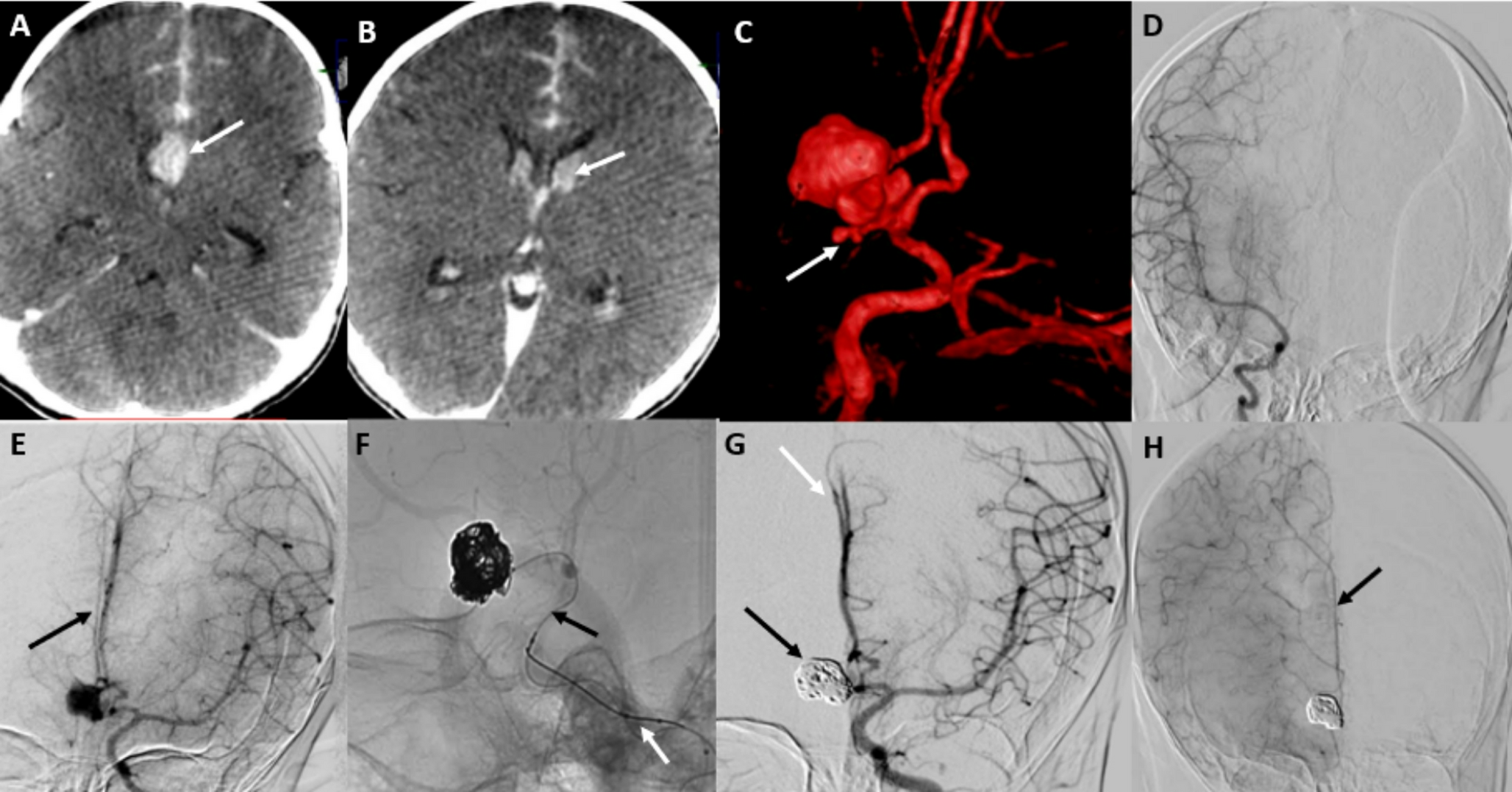 Endovascular management of a ruptured complex ACoM aneurysm in a 9-month-old infant: a rare case report and literature review