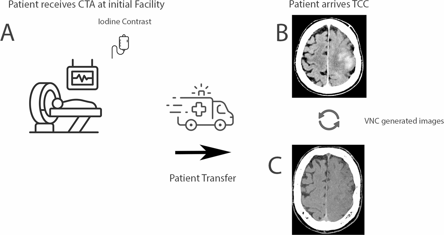The delayed spectral sign in Post-transfer CT imaging: an imaging marker of stroke severity and hemorrhagic risk