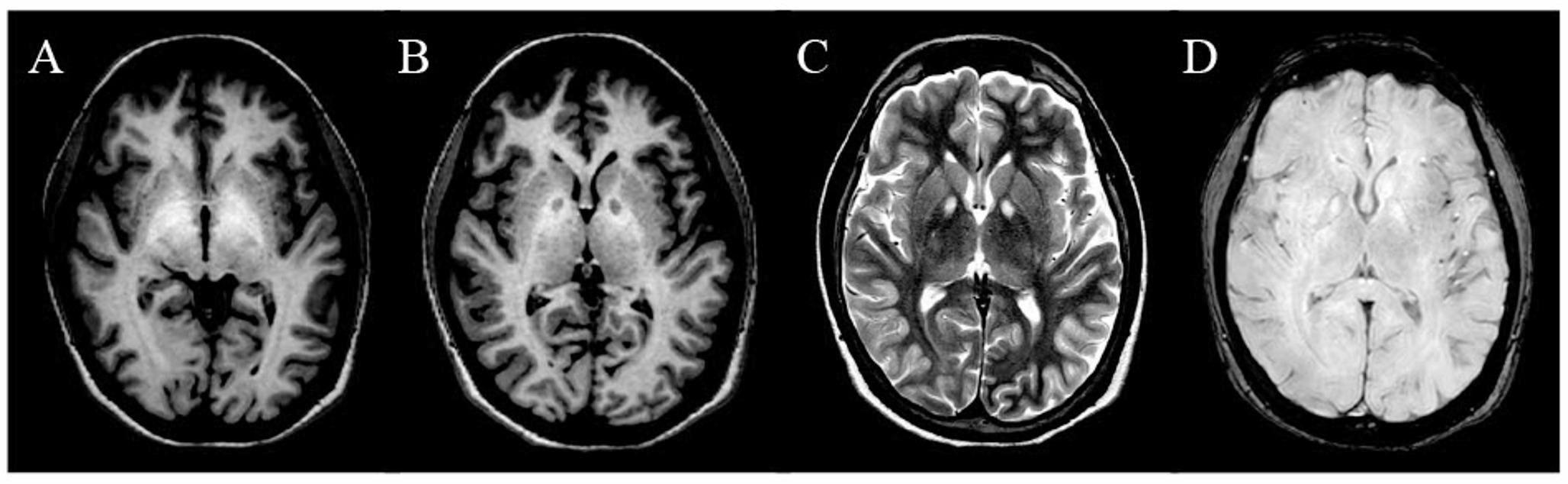 in acquired hepatocerebral degeneration