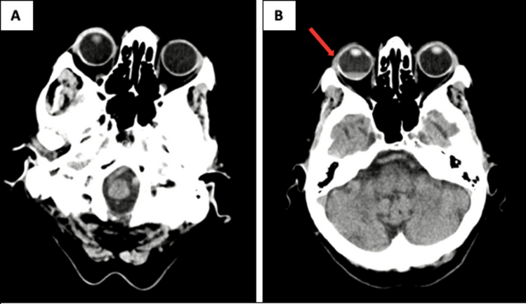 Blurred vision after thrombolysis