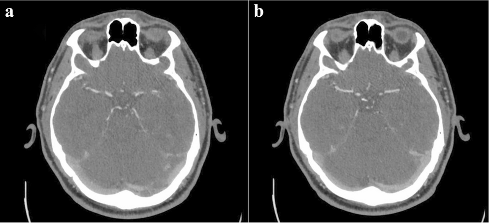 Multimodal imaging reveals intracranial stenosis in a young patient with cryptogenic borderzone stroke