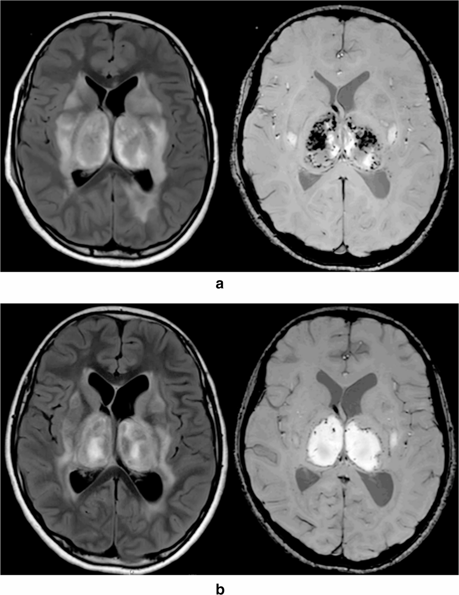Intrathecal dexamethasone for pediatric influenza-associated acute necrotizing encephalitis