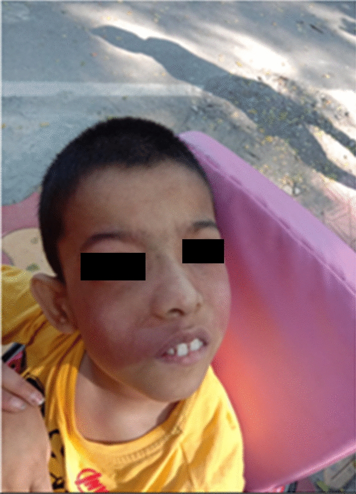 Ossifying Fibroma: A Case Report of an Unusual Presentation of Angiodysplastic Disease with Review of Literature