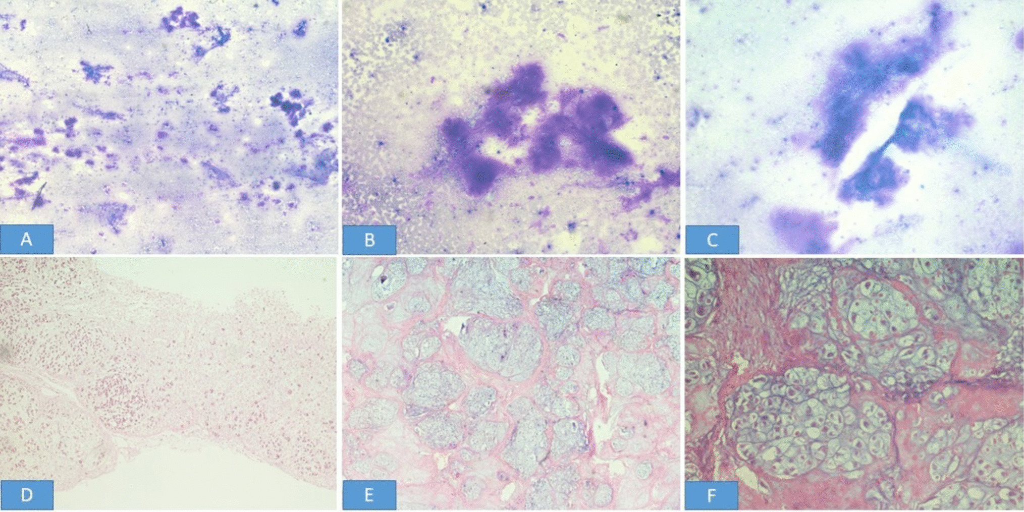 Primary Chondrosarcoma of the Breast: A Diagnostic and Histopathologic Challenge