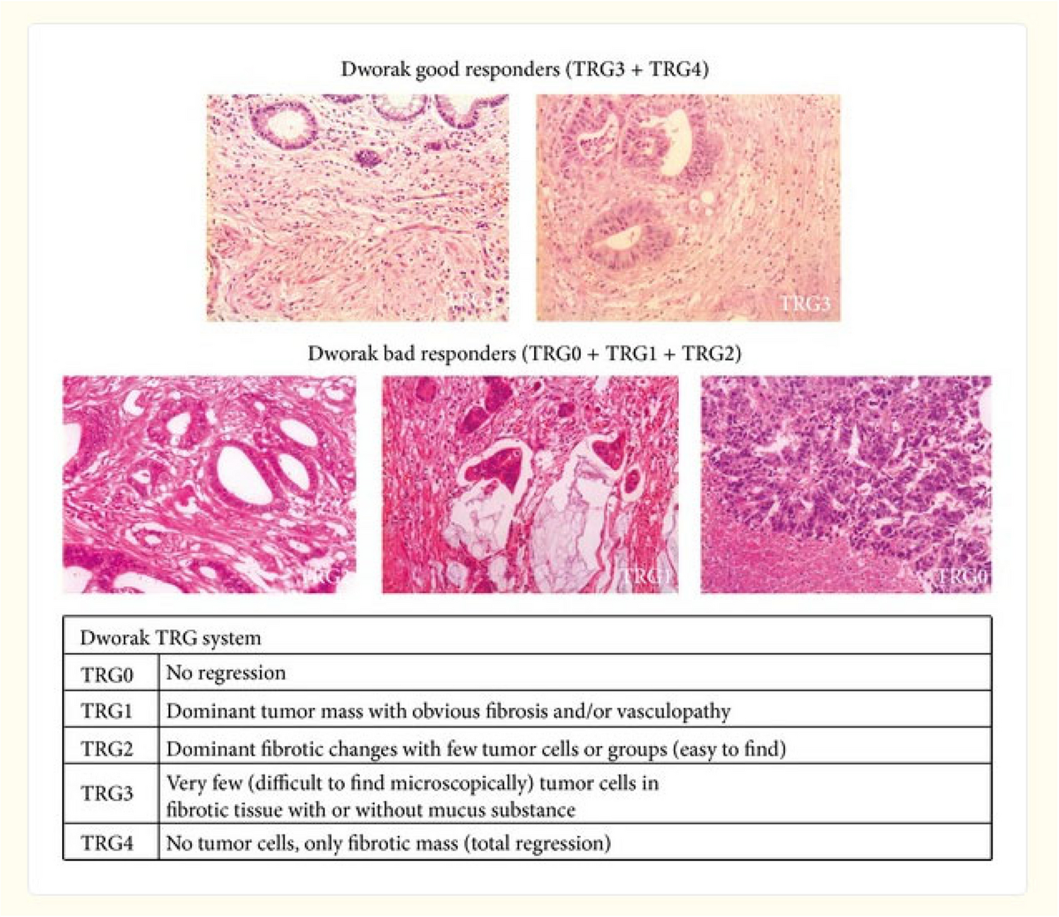 Total Neo-adjuvant Therapy [TNT] with Short Course Radiotherapy [SCRT] Followed by Total Mesorectal Excision [TME]– in Locally Advanced Rectal Cancer [LARC]: a Prospective Observational Study in an Indian Population