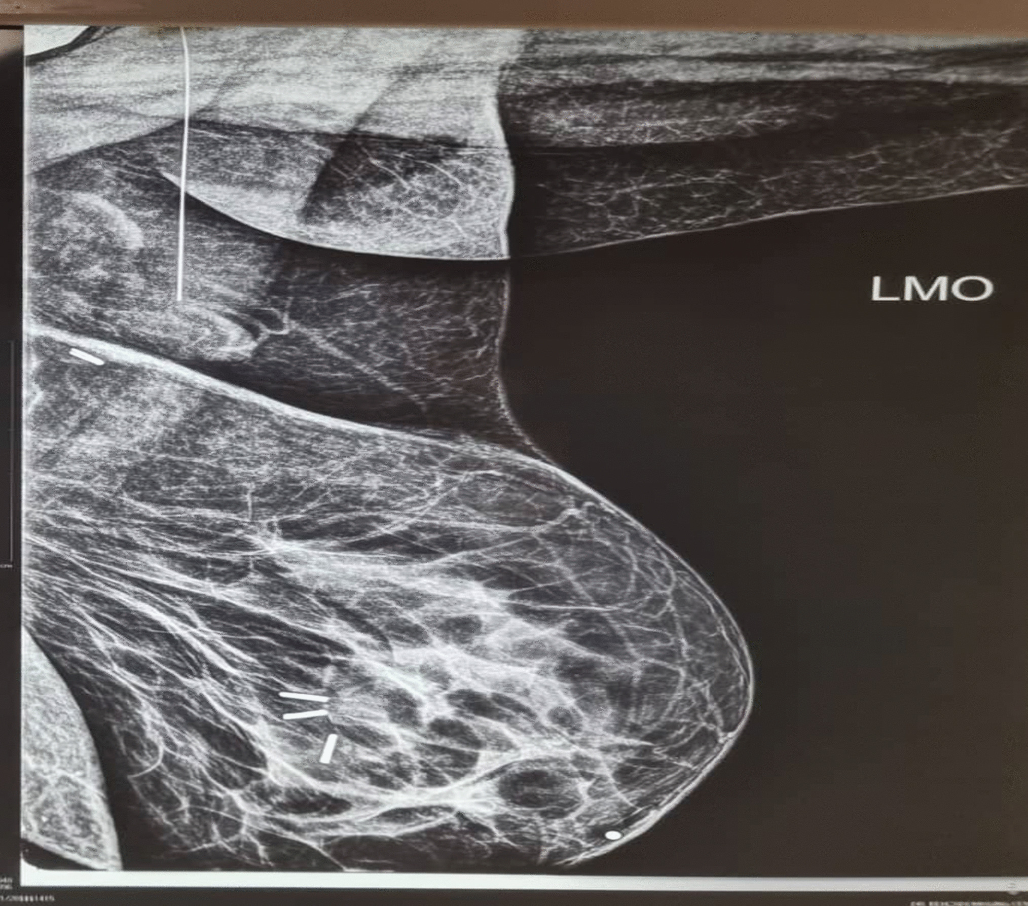 Migration of Preoperative Breast Localization Wire: A Case Report