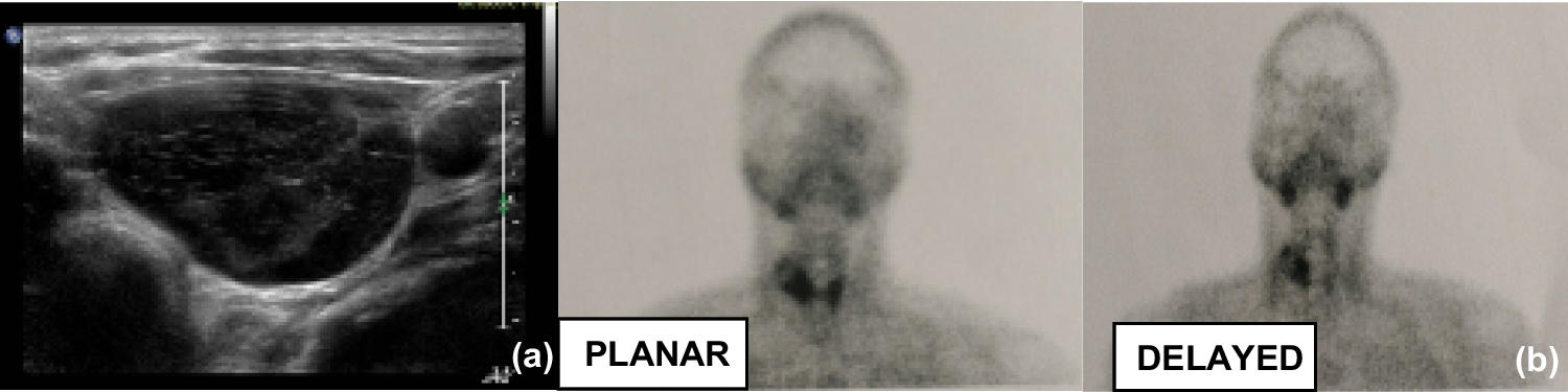 Unravelling Preoperative and Intraoperative Parathyroid Adenoma Localization (PIPAL Study)—From a high-volume tertiary care centre in India