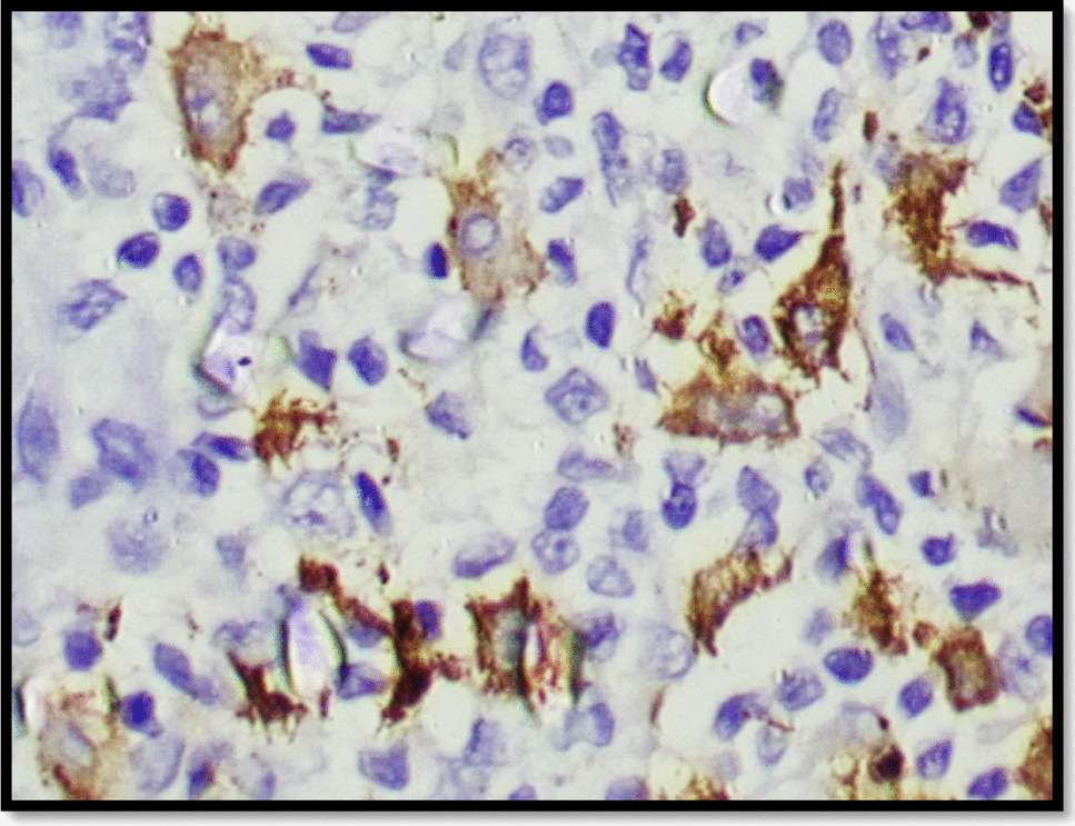Immunohistochemical Study of Tumour-Associated Macrophages Using CD68 and CD163 in Oral Squamous Cell Carcinoma