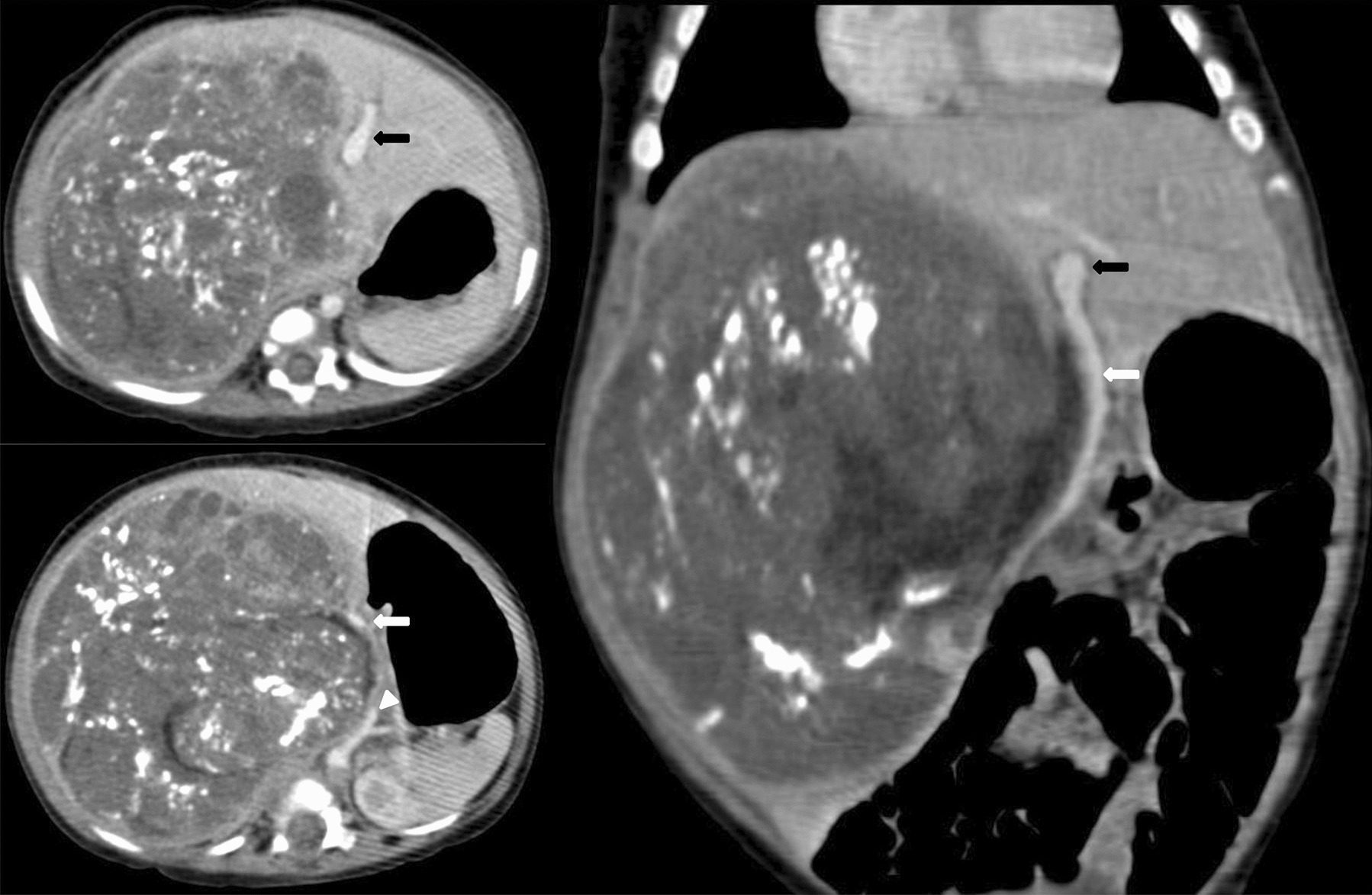 Intraoperative Stenting of Hepatic Ducts to Aid Dissection in an 8-Month-Old Child with Large Hepatoblastoma and Severe Porta Distortion