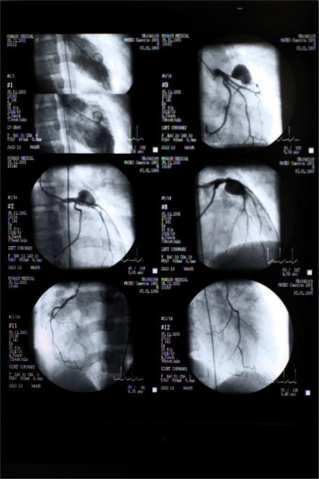 Family reflections: Kawasaki Disease 30 years after diagnosis; a parent’s perspective