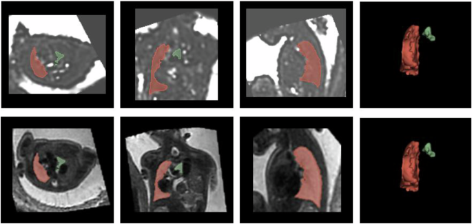 Pulmonary T2* quantification of fetuses with congenital diaphragmatic hernia: a retrospective, case-controlled, MRI pilot study