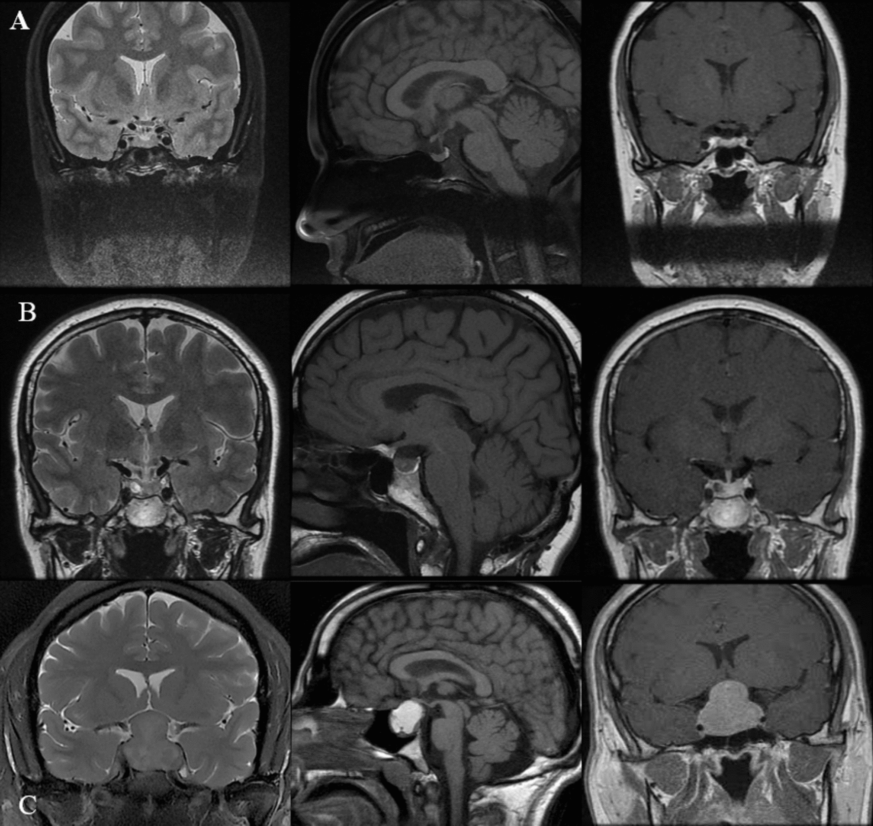 A novel hybrid convolutional and recurrent neural network model for automatic pituitary adenoma classification using dynamic contrast-enhanced MRI