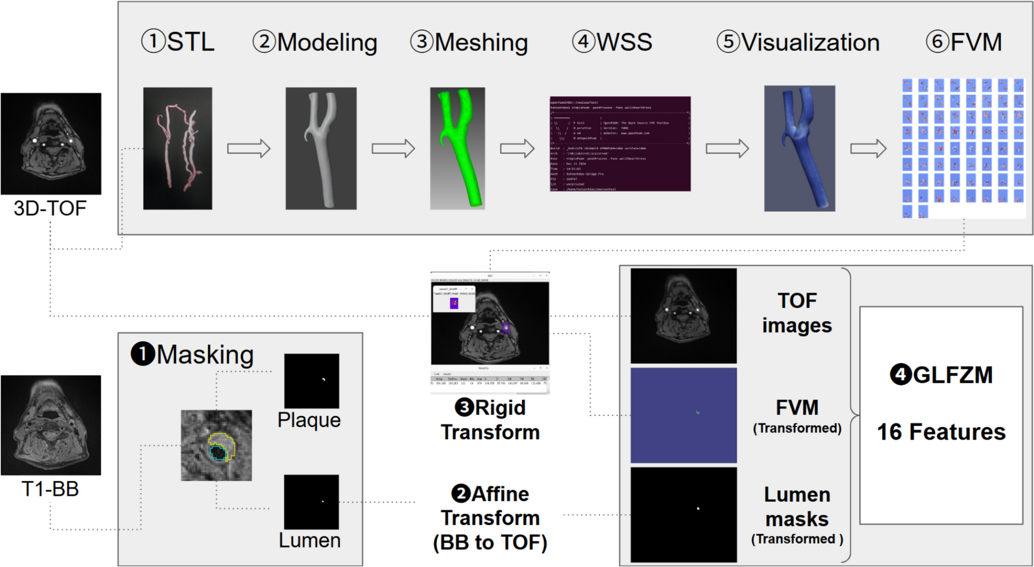 Integrating MRI radiomics with novel fluid-based texture features (GLFZM) to predict atherothrombotic stroke risk