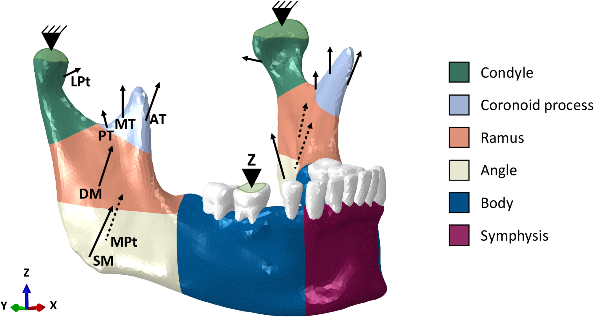 Impact of osteotomy angle on bone failure risk in a modified pull-through approach: a finite element analysis