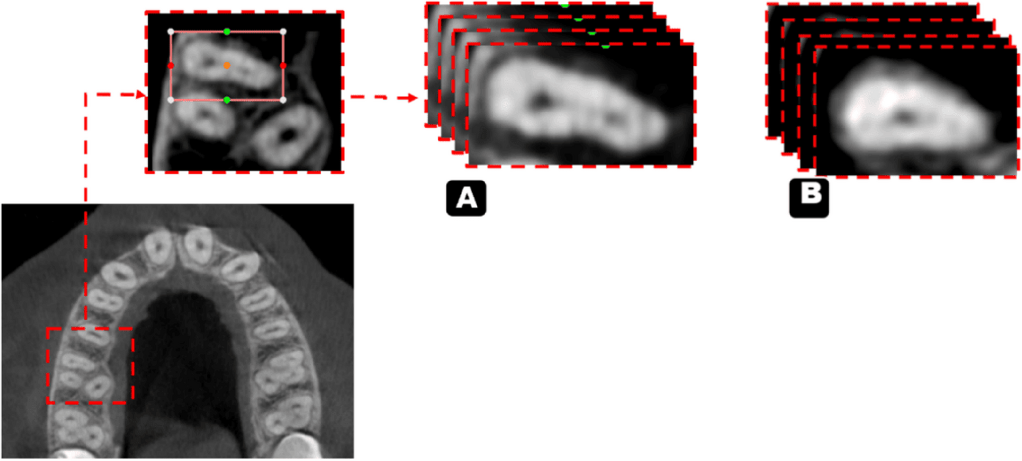 Two step approach for detecting and segmenting the second mesiobuccal canal of maxillary first molars on cone beam computed tomography (CBCT) images via artificial intelligence
