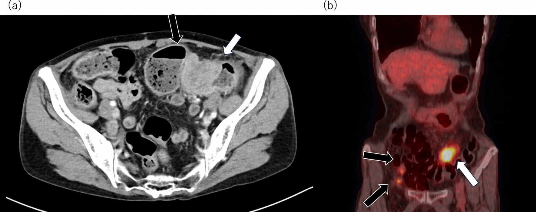 Serous endometrial carcinoma metastatic to the sigmoid colon masquerading as a primary colon cancer detected by bowel obstruction