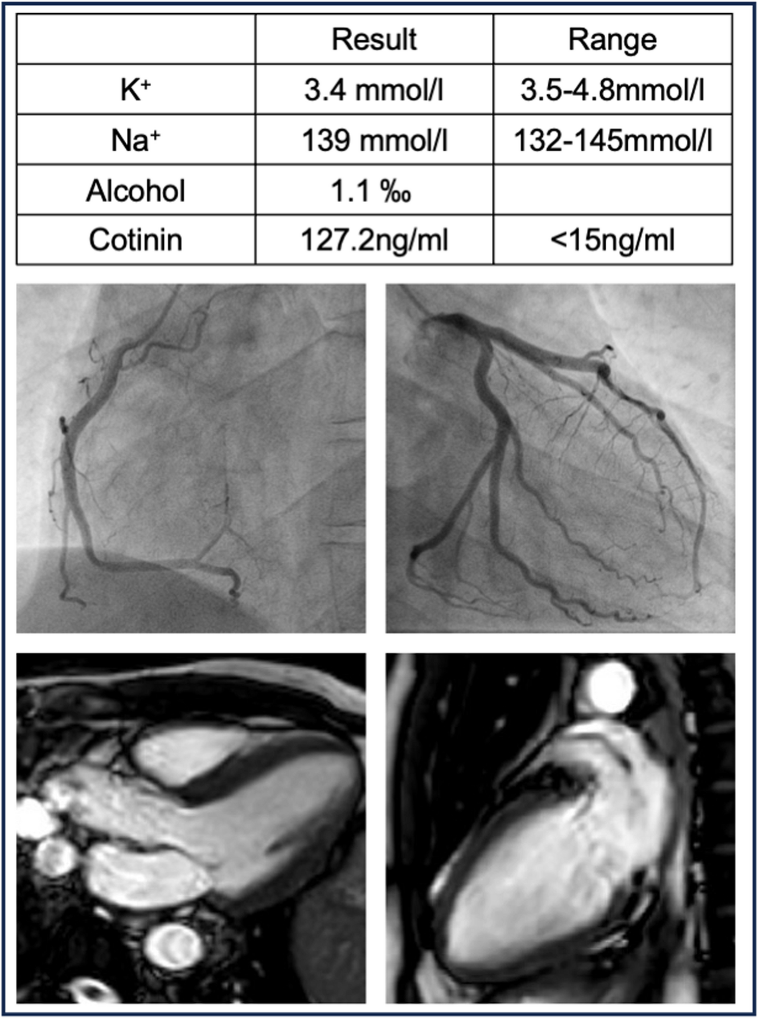 Early repolarization pattern with oral liquid nicotine