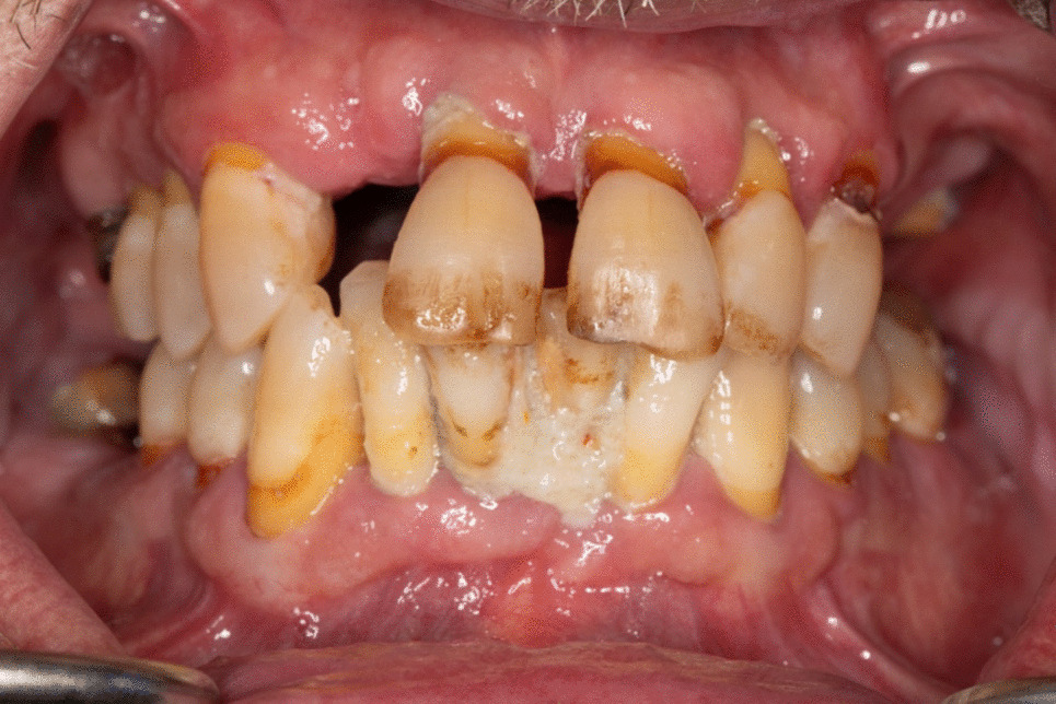 Inflammatory Association between Periodontal Disease and Systemic Health