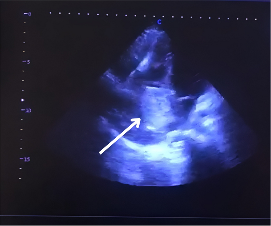 Giant right atrial myxoma emerging from the suprahepatic inferior vena cava, extending to the right atrium; a case report and literature review