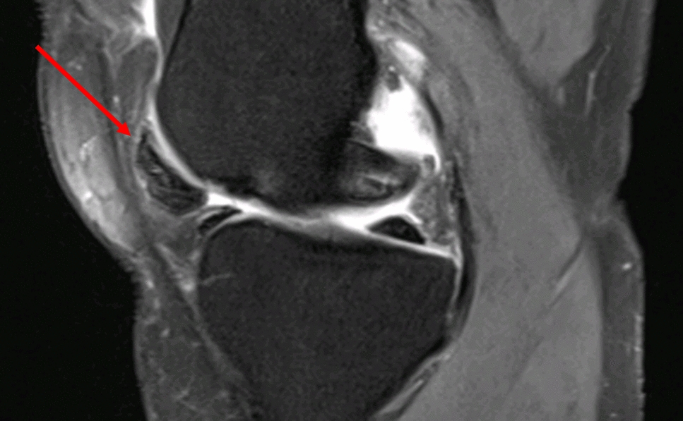 Hoffa–Kastert Syndrome: A Rare Cause of Acute Knee Blockade
