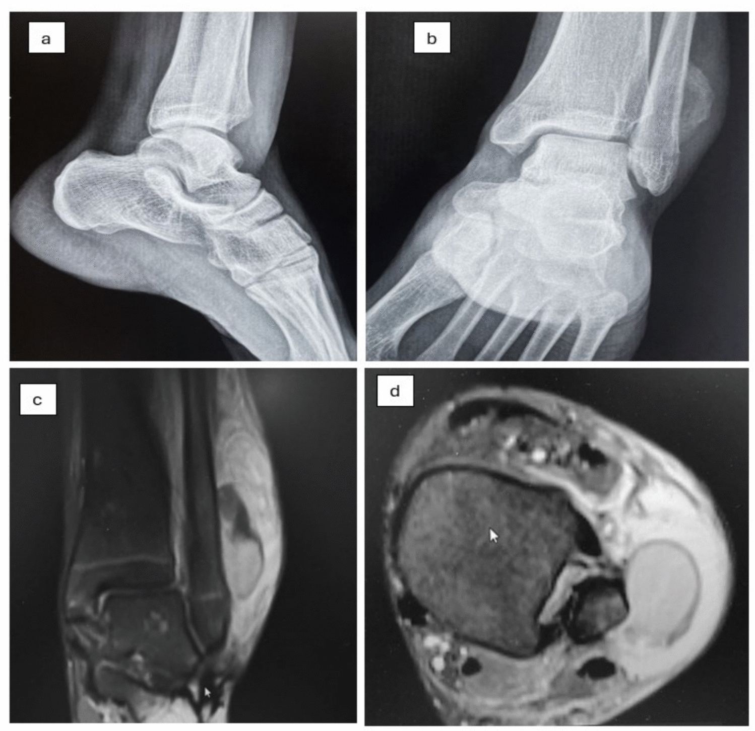First Acute Case of Ossifying Subperiosteal Hematoma After Plexiform Neurofibroma Resection in NF-1: Case Report and Systematic Review