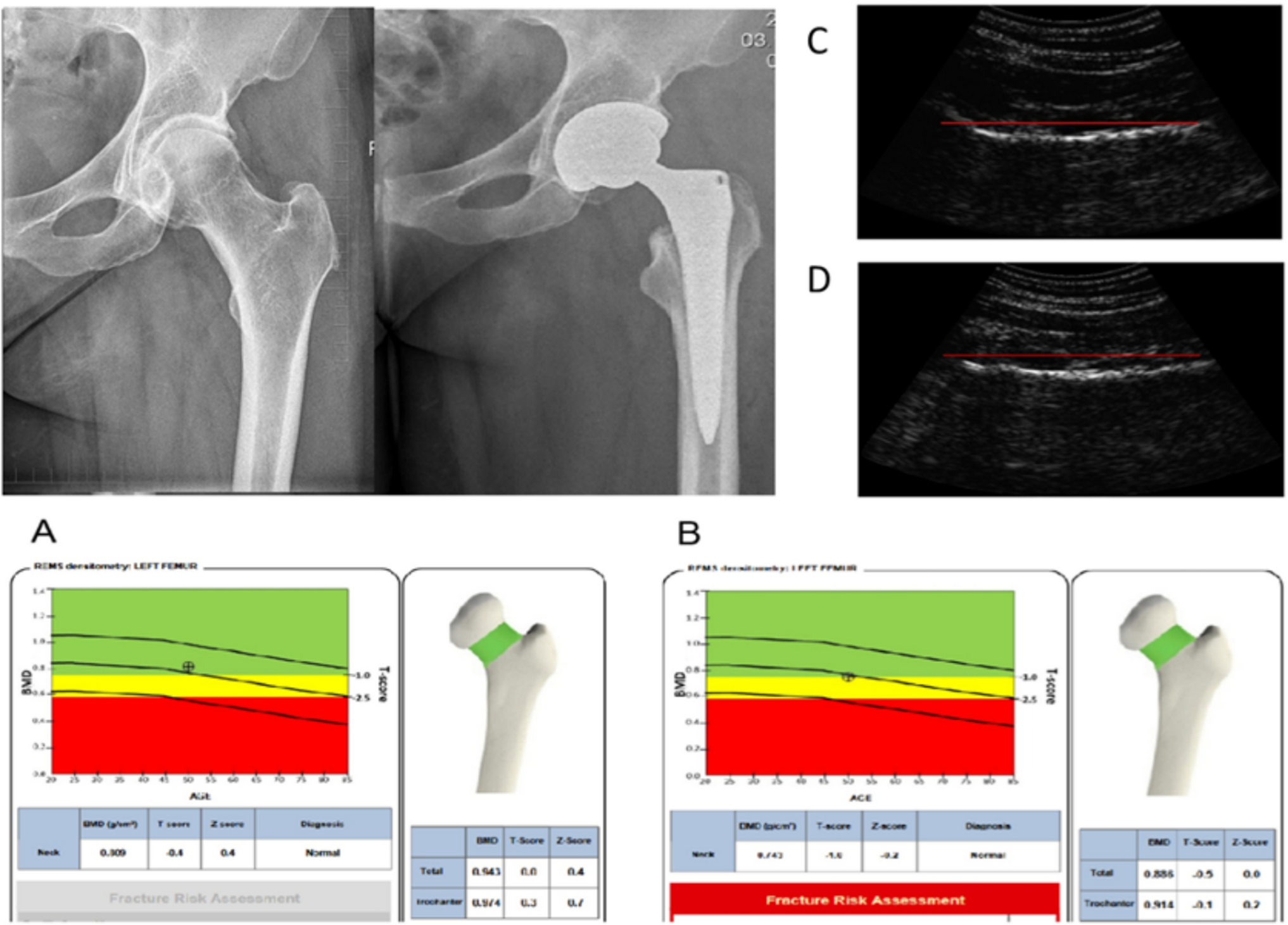 Bone mineral density assessment using radiofrequency echographic multispectrometry (REMS) in patients before and after total hip replacement