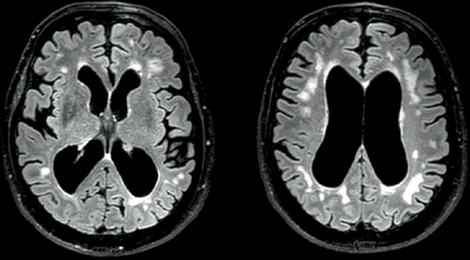 Myotonic dystrophy type 1: clinical diversity, molecular insights and therapeutic perspectives
