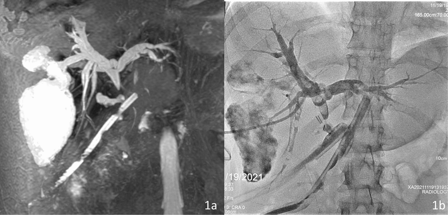 Percutaneous Transhepatic Reconstruction of a Completely Transected Common Bile Duct Without Endoscopic Assistance: A Case Report