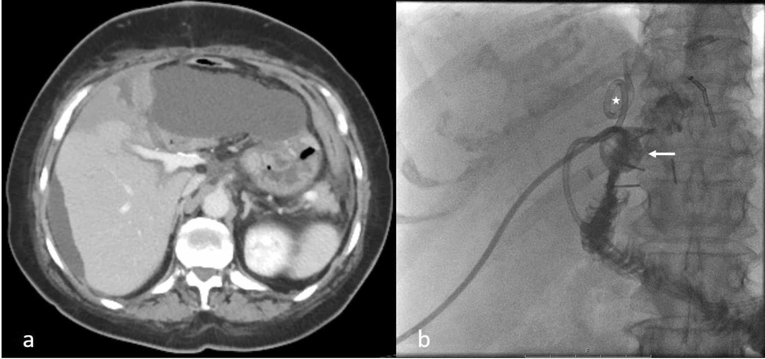 Selective Portal Vein Embolisation for Management of Excluded Bile Duct Leak