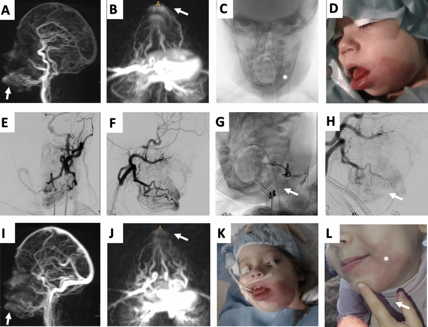 Combining Reversible Electroporation and Bleomycin in Treatment of Arteriovenous Malformations