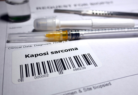 Genetic “Trojan horse” selectively kills cancer cells linked to Kaposi’s sarcoma