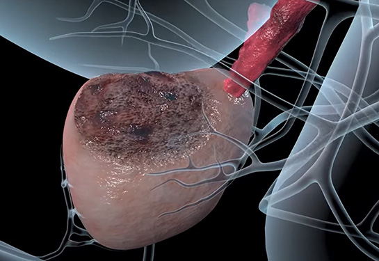 Advanced tissue imaging to improve prostate cancer surgeries