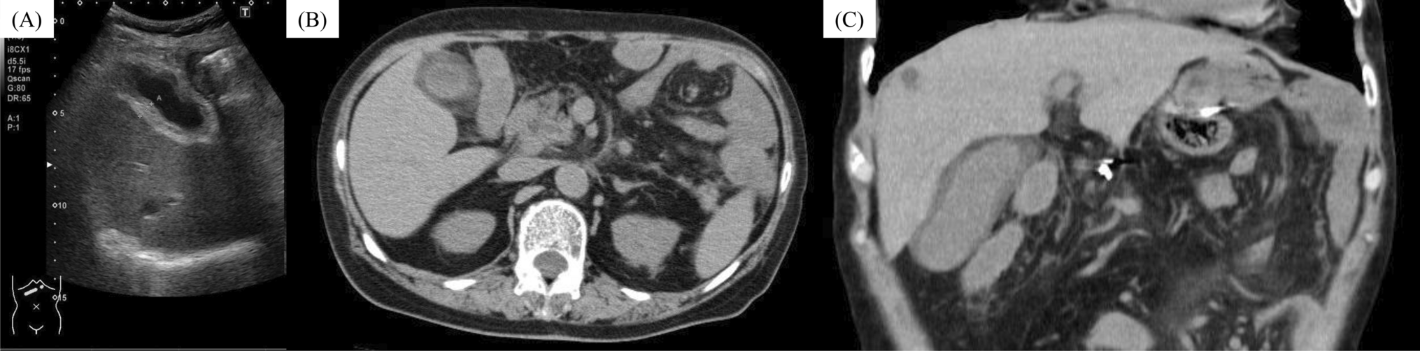 Gallbladder edema as a clue to zolbetuximab-associated protein-losing enteropathy in gastric cancer: a case report