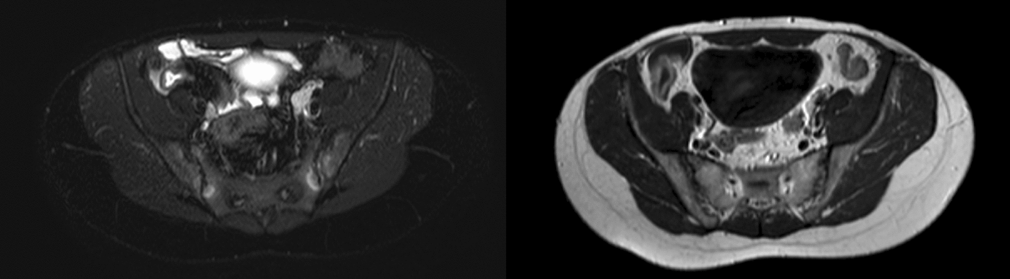 Prevalence of sacroiliitis on magnetic resonance enterography in Crohn’s disease and its association with intestinal findings: a monocentric observational cross-sectional study
