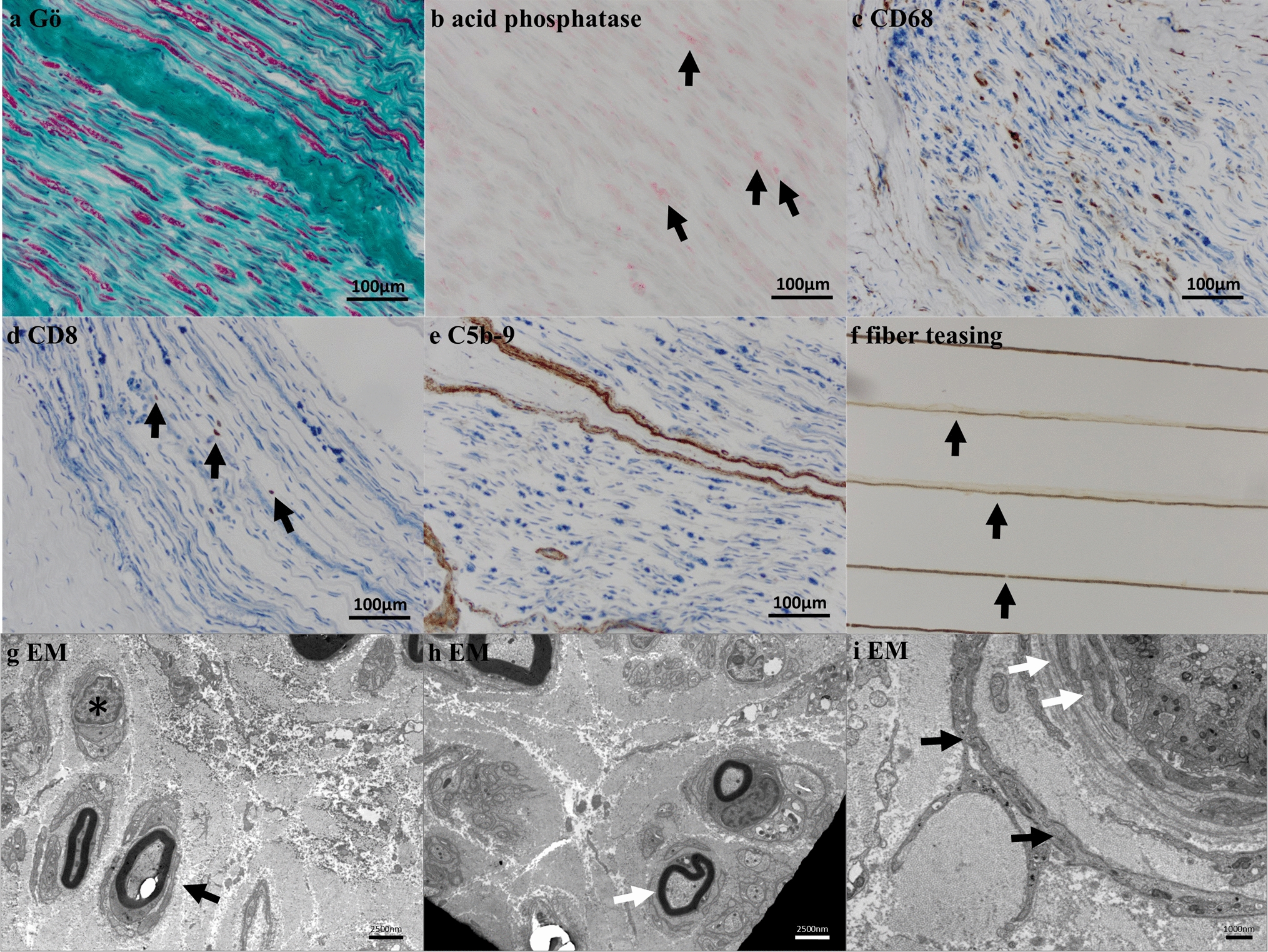 Complement profiling of sural nerves in chronic-inflammatory demyelinating polyneuropathy