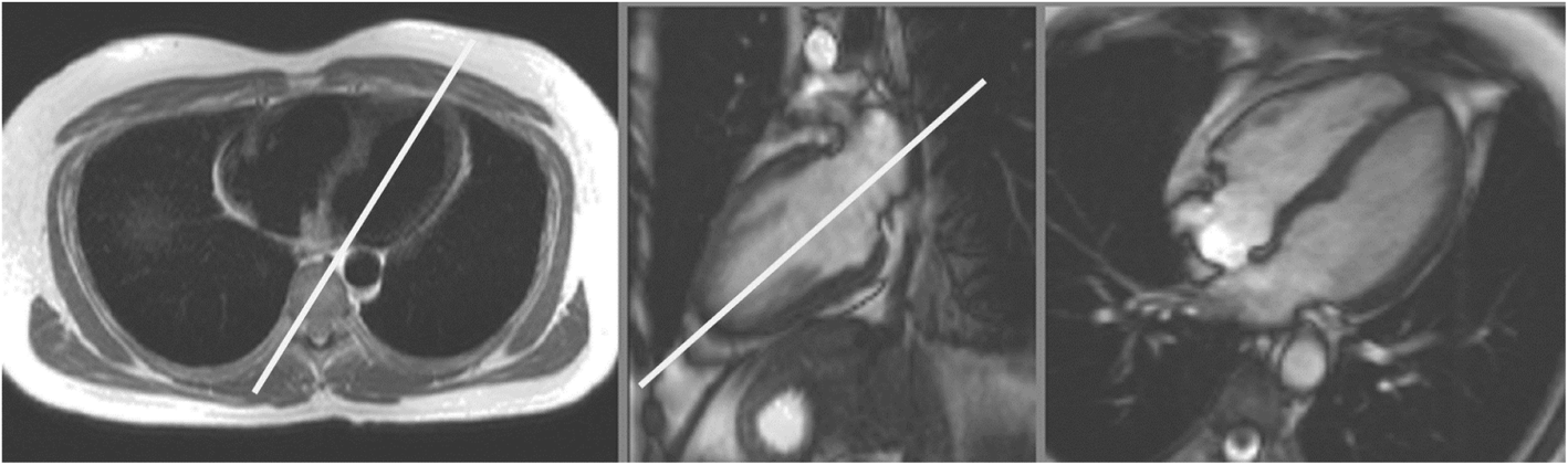 Standardized cardiovascular magnetic resonance imaging (CMR) protocols: 2020 update