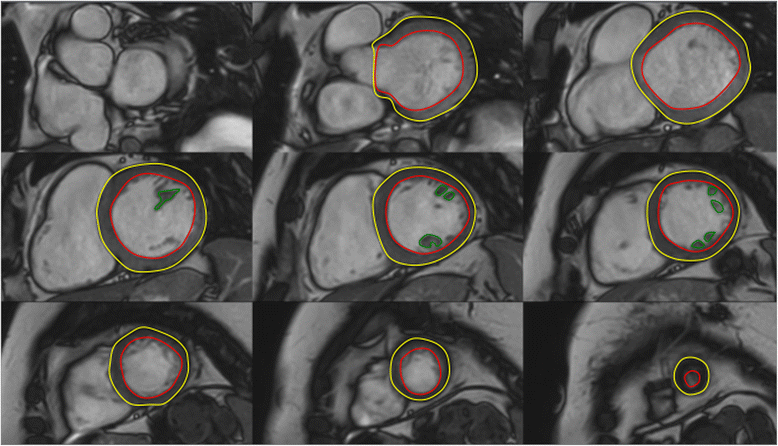Normal values for cardiovascular magnetic resonance in adults and children